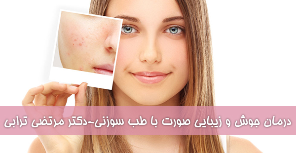 درمان جوش و زیبایی صورت با طب سوزنی